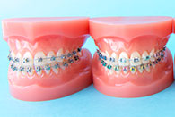 大人の矯正治療