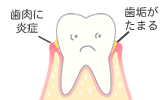 歯垢がたまる　歯肉に炎症