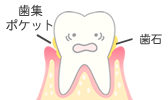 歯周ポケット　歯石