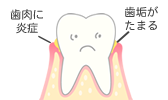 歯垢がたまる 歯肉に炎症