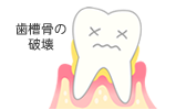 歯槽骨の破壊