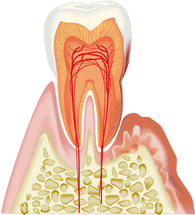 歯周病